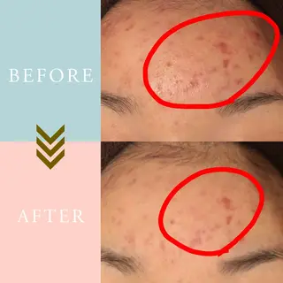 ニキビケア/毛穴/ 赤み/自信の肌✨森園のエステ・リラクイメージ