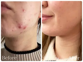 ニキビ・ 肌荒れ専門店のエステ・リラクイメージ