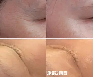 顔脱毛＆毛穴＆ニキビ 優良№1♪ヒロコ♪のエステ・リラクイメージ