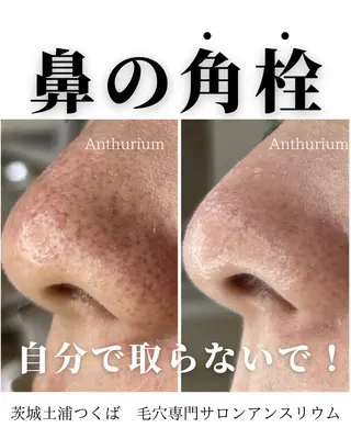 毛穴ケア専門サロンアンスリウム所属・茨城土浦 つくば毛穴 ケア専門サロンのエステ・リラクイメージ