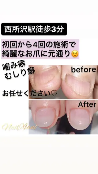 ネイル Nail×Lani 深爪矯正対応◎のネイルデザイン