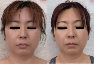 レチノール/ニキビ/ 毛穴ケア 浅川のエステ・リラクイメージ