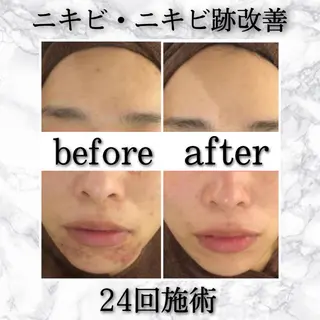 ショート カラー パーマ ヘアアレンジ メンズ キッズ ネイル マツエク・マツパ アイブロウ ニキビ特化型エステ 🍓最短で肌質改善のエステ・リラクイメージ