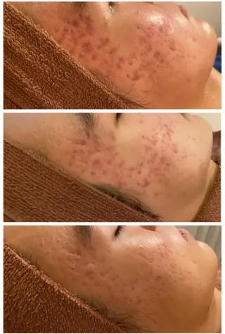 🔥3か月で肌革命 🔥ニキビ専門店のエステ・リラクイメージ