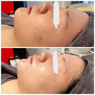 毛穴改善ハーブピーリングMinouミヌ心斎橋所属・ミヌ心斎橋 あやめのエステ・リラクイメージ