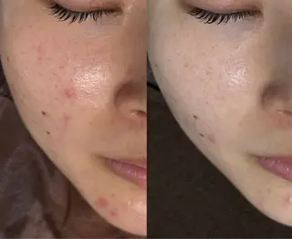 お肌のかかりつけサロンP.A.L.M.所属・【P.A.L.M.】 むき卵×毛穴レス肌のエステ・リラクイメージ