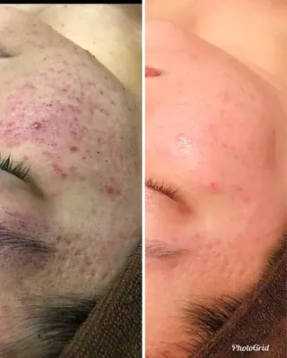 【リベルハーブピーリング認定店】敏感肌・美白脱毛専門店Dione立川店所属・Dione 立川店のエステ・リラクイメージ