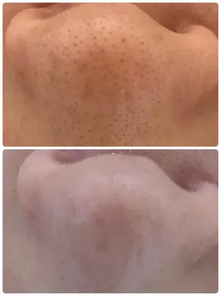 小顔・毛穴/ニキビ/ ハーブピーリング専門のエステ・リラクイメージ