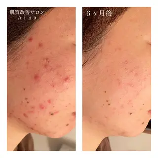 セミロング カラー パーマ ヘアアレンジ メンズ キッズ ネイル マツエク・マツパ ニキビ跡専門サロン Ainaのエステ・リラクイメージ