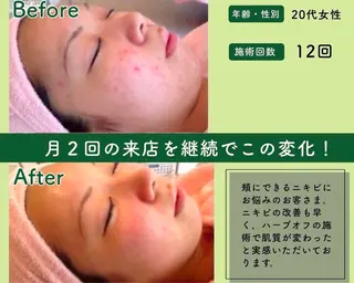 M.plus所属・水光韓国肌ハーブ ピーリングMplusのエステ・リラクイメージ