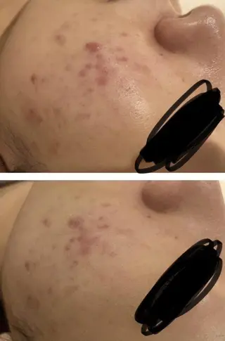 セミロング カラー パーマ ヘアアレンジ メンズ キッズ ネイル マツエク・マツパ アイブロウ ニキビ特化型エステ 🍓最短で肌質改善のエステ・リラクイメージ