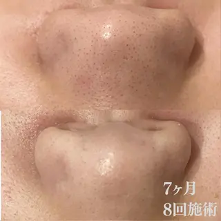 学生ニキビ改善🍀 優しい肌質改善のエステ・リラクイメージ