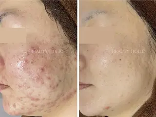 ニキビ・ 肌荒れ専門店のエステ・リラクイメージ