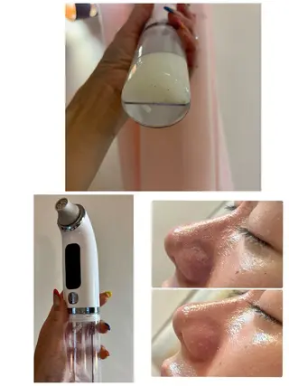 ハーブピーリング/韓国肌管理/フェイシャル/毛穴洗浄/眉毛/顔脱毛【糸脱毛専門】rev所属・ハーブピーリング🌹 毛穴洗浄❤️眉waxのエステ・リラクイメージ