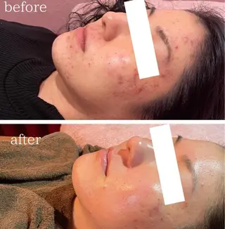 ハーブピーリング /毛穴ケア/脱毛/韓国ツヤ肌専門店【HARU.】所属・韓国ツヤ肌ピーリング ハーブ脱毛HARU.のエステ・リラクイメージ