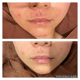 セミロング カラー パーマ ヘアアレンジ メンズ キッズ ネイル マツエク・マツパ アイブロウ ニキビ特化型エステ 🍓最短で肌質改善のエステ・リラクイメージ