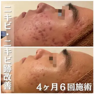 学生ニキビ改善🍀 優しい肌質改善のエステ・リラクイメージ