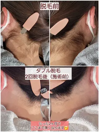 A*[エースター] シュガーリング🍋のエステ・リラクイメージ