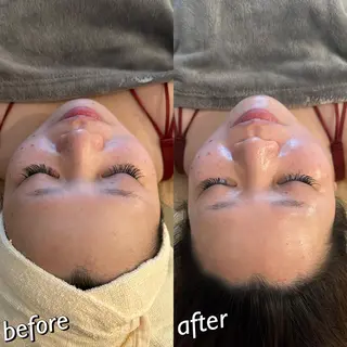 うなじ脱毛/美肌脱毛 LABELのエステ・リラクイメージ