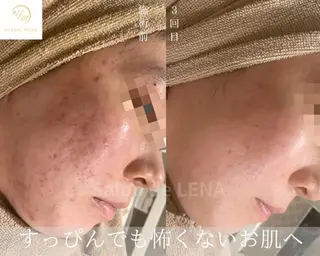 Grandir所属・ハーブピーリング専門 グランディール　武内のエステ・リラクイメージ