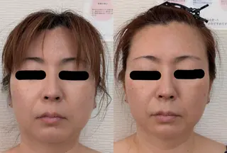 レチノール/ニキビ/ 毛穴ケア 浅川のエステ・リラクイメージ