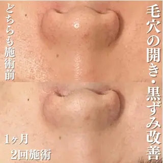 学生ニキビ改善🍀 優しい肌質改善のエステ・リラクイメージ