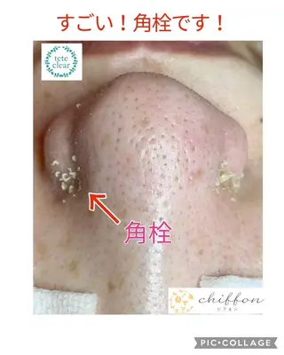 毛穴黒ずみ改善🥇 ✨シフォン豊田✨のエステ・リラクイメージ