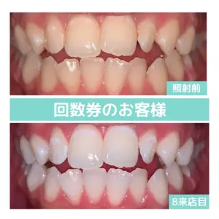 ホワイトニング｜韓国式3D毛穴洗浄 lonhana ﾛﾝﾊﾅ所属・韓国式3D毛穴洗浄 lonhanaのその他イメージ