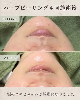 シミ毛穴|眉Wax THE  flowのエステ・リラクイメージ