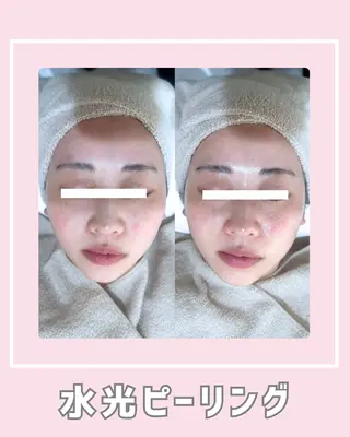 |ピーリング・毛穴| soina神楽坂のエステ・リラクイメージ