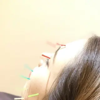 🌈リフトUP🫶 美容鍼 🌈 コナンのエステ・リラクイメージ