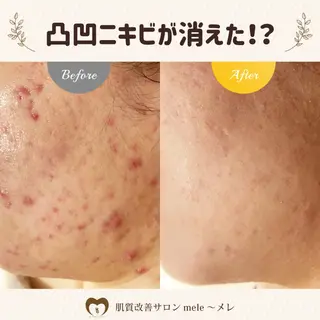 ニキビケア/毛穴/ 赤み/自信の肌✨森園のエステ・リラクイメージ