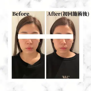 12Dハイフ💗 最強小顔のエステ・リラクイメージ