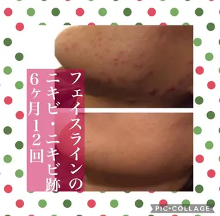 ニキビ跡改善専門🔥 医療にはできない改善のエステ・リラクイメージ
