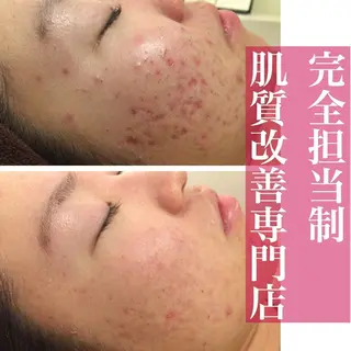 ニキビ特化型エステ 🍓最短で肌質改善のエステ・リラクイメージ