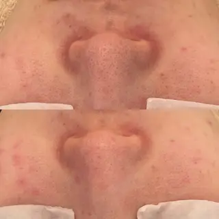 毛穴ケア/毛穴診断/ 毛穴洗浄〔心斎橋〕のエステ・リラクイメージ