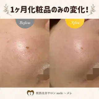 ニキビケア/毛穴/ 赤み/自信の肌✨森園のエステ・リラクイメージ