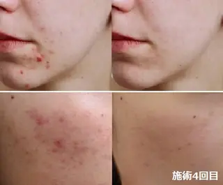 顔脱毛＆毛穴＆ニキビ 優良№1♪ヒロコ♪のエステ・リラクイメージ