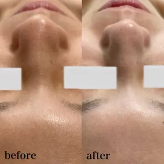 ハーブピーリング/韓国肌管理/フェイシャル/毛穴洗浄/眉毛/顔脱毛【糸脱毛専門】rev所属・ハーブピーリング🌹 毛穴洗浄❤️眉waxのエステ・リラクイメージ