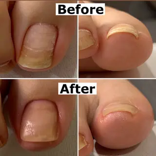 ネイル Mellow nail所属・巻爪無料モデル募集 ✨🦶MEGUMIのネイルデザイン