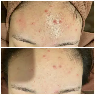 ニキビ特化型エステ 🍓最短で肌質改善のエステ・リラクイメージ