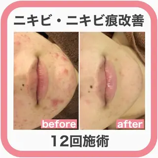 学生ニキビ改善🍀 優しい肌質改善のエステ・リラクイメージ