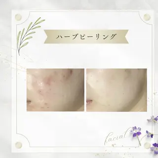 《 肌質改善 》 addissimoのエステ・リラクイメージ