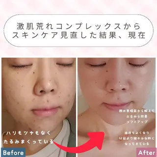 痩身ハーブピーリング 筋膜リリース☆B&Hのエステ・リラクイメージ