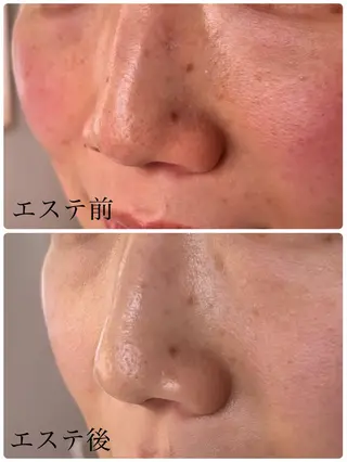 YUI🤍肌悩みに ＊速攻透明感！のエステ・リラクイメージ