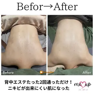 Meupニキビ専門店 背中/ハーブ/肌管理のその他イメージ