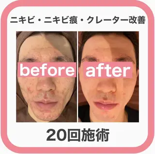 学生ニキビ改善🍀 優しい肌質改善のエステ・リラクイメージ