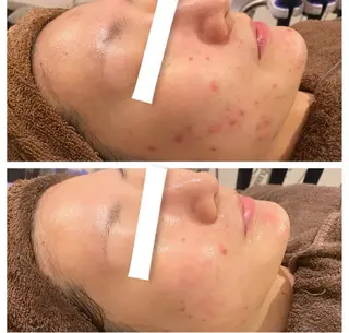 ハーブピーリング🌿 kyokoのエステ・リラクイメージ