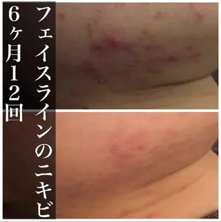 ショート カラー パーマ ヘアアレンジ メンズ キッズ ネイル マツエク・マツパ アイブロウ 夏までに肌荒れ卒業 するサロン🌻のエステ・リラクイメージ