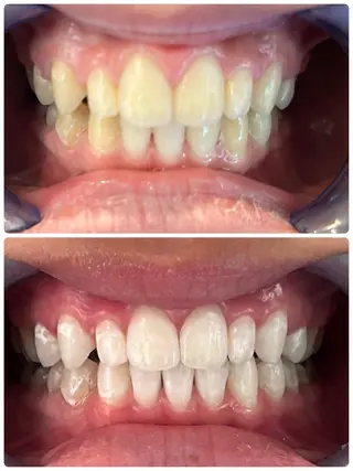 歯のセルフホワイトニング専門店GLOW（グロウ）所属・東区香椎歯のセルフホ ワイトニングGLOWのその他イメージ